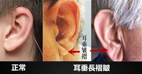 耳垂突然變大|耳垂出現「褶痕」代表心血管出問題了？心臟科醫師解。